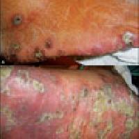 Pustular Psoriasis Treatment