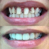 Smile Makeovers/Veneers Service