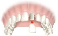 Dental Crowns