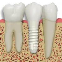 Dental Implants