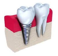 Dental Implants