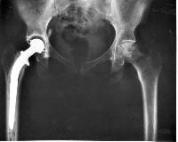 orthopedic hip prosthesis