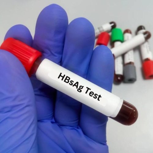 Hepa Scan Hbsag Test Kit