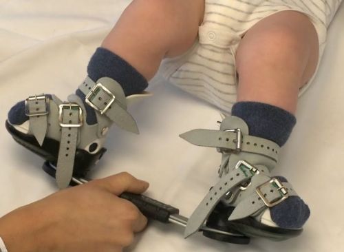 Clubfoot Db Splint