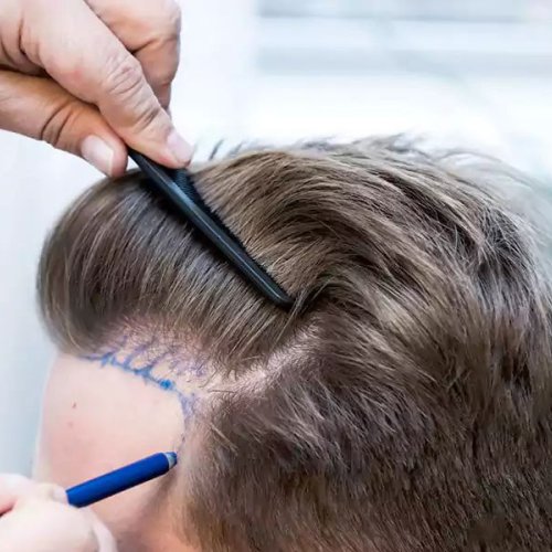 FUE Hair Transplant Service