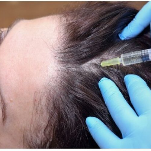 PRP Hair Treatment Service