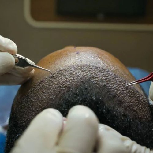 Hair Grafting Surgery