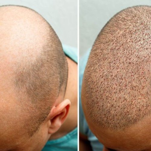 Hair Transplant Service