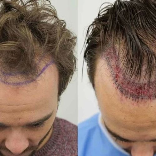 Permanent Hair Restoration