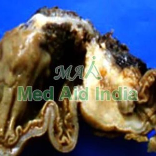 Signet Ring Carcinoma Descending Colon Gross Specimen