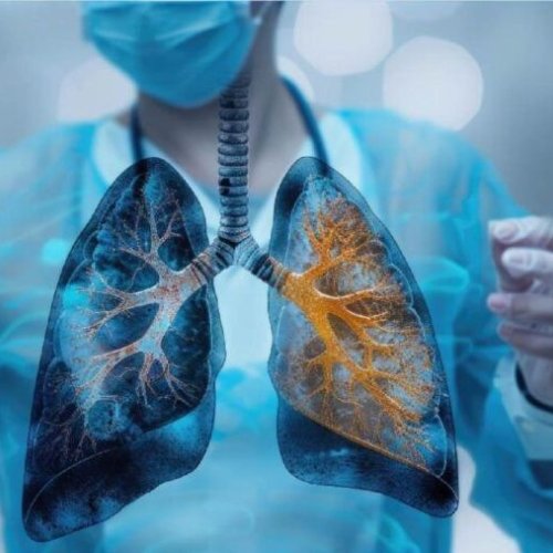 Lung Cancer Treatment Service