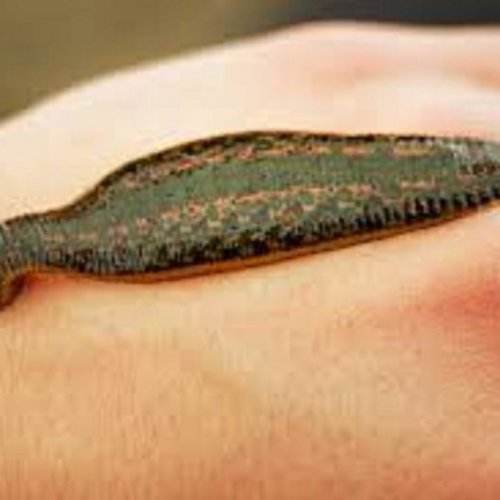 Leech Therapy