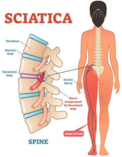 Sciatica Pain Acupressure Therapy Service