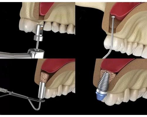 Xcem Osspore Bone Grafts For Sinus And Implantitis Repair