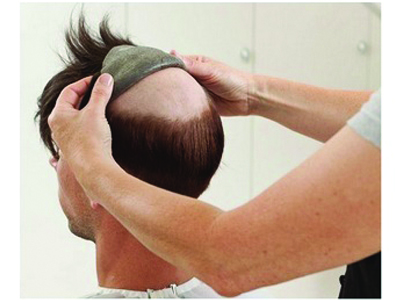 Non Surgical Hair Replacement in Chennai India