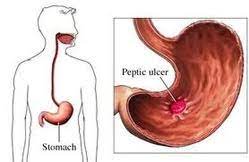 Gastric Ulcer Treatment
