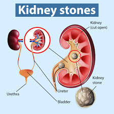 Kidney Stone Removal Treatment