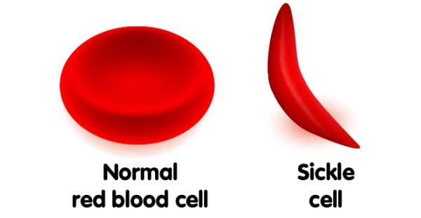 Sickle Cell Anemia Treatment