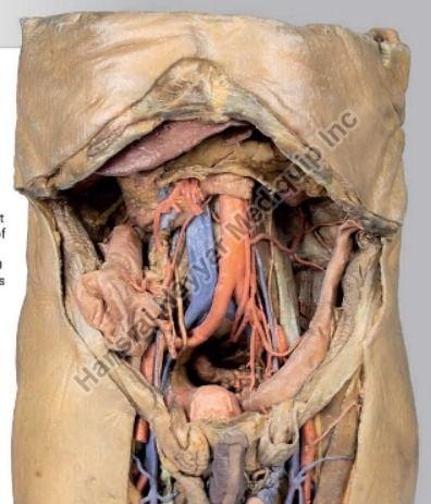 Abdomen with Bilateral Hernias 3D Anatomical Model