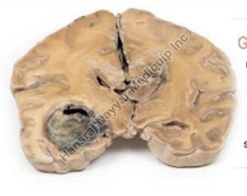 Glioblastoma Multiforme 3D Anatomical Model