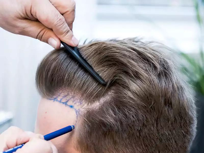 FUE Hair Transplant Service