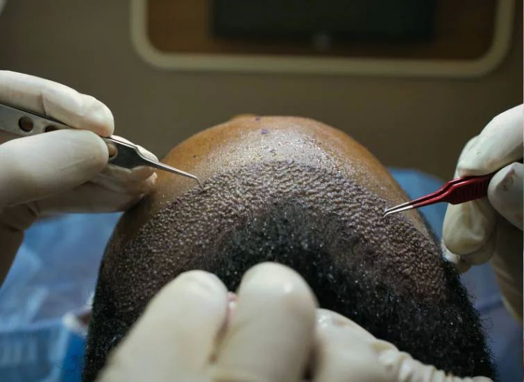 Hair Grafting Surgery