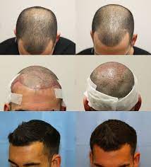 Hair Transplant Growth Result