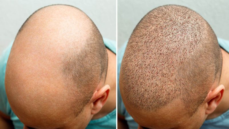 Hair Transplant Service