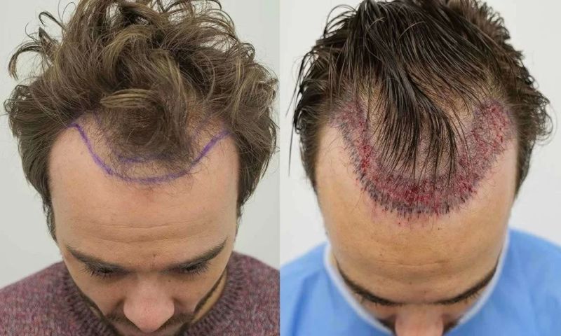 Permanent Hair Restoration