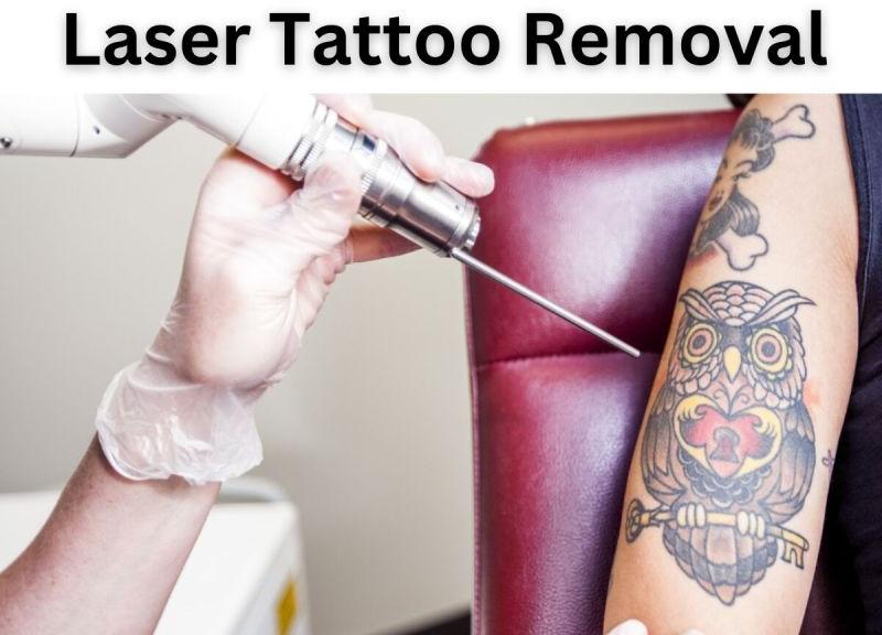 Laser Tattoo Removal Treatment