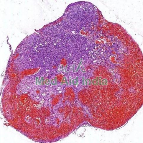 Capillary Hemangioma