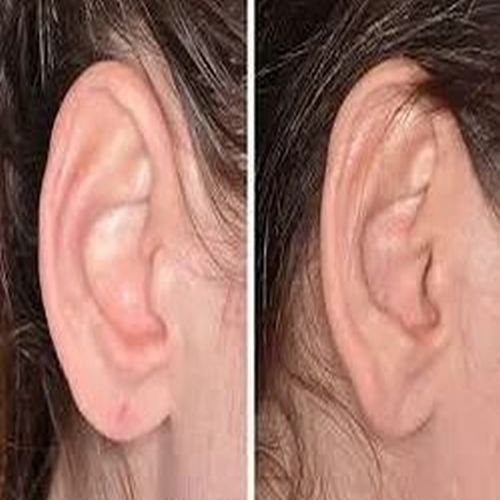 Ear Lobe Repairing Services