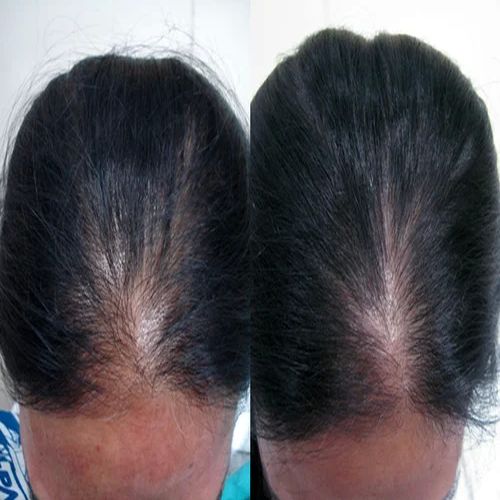 Hair Fall & Hair Regrowth Treatment