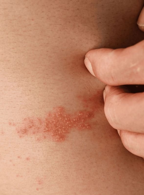 Bacterial Skin Infection Treatment