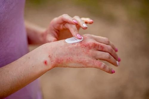 Eczema Treatment Service