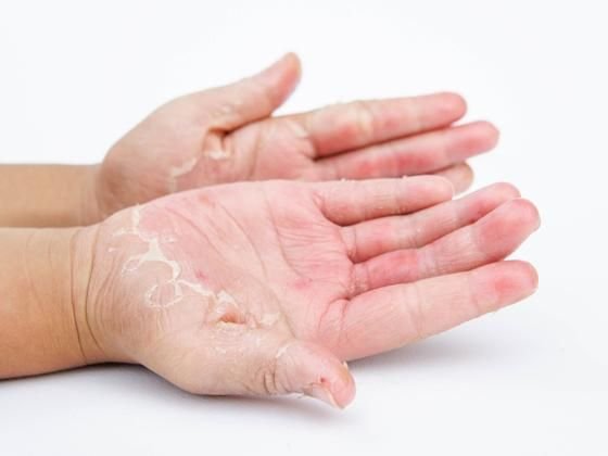 Skin Infection Treatment Service