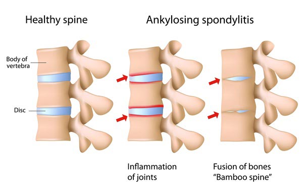 Yoga Treatment for Ankylosing Spondylitis