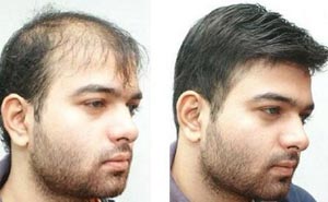 Non Surgical Hair Replacement Services in Delhi,Hair Replacement Services
