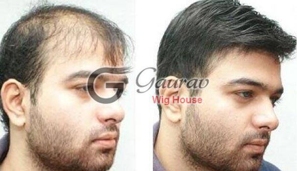 Hair Fixing - Find Top Hair Fixing Services in Delhi, India - GauravWigHouse