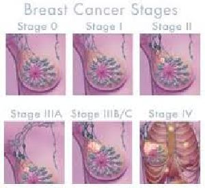 H Breast Cancer
