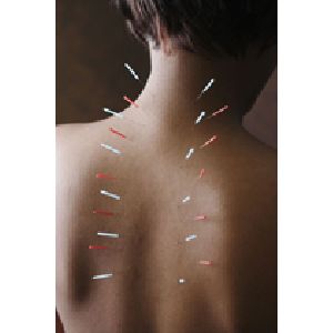 acupuncture needle