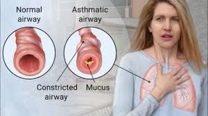 C Allergy and Asthma
