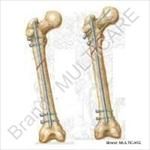 Femur & Expart Nail