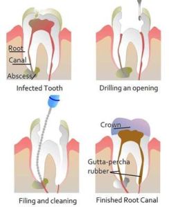 Root canal Treatment in Coimbatore