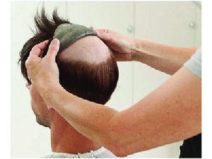 Non Surgical Hair Replacement
