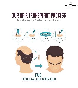 hair transplantation services