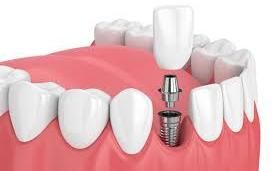 Dental Implants