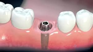 Dental Implants