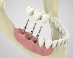 Dental Implants