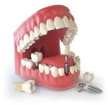 Dental Implants